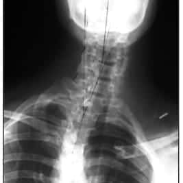 meyerxray1