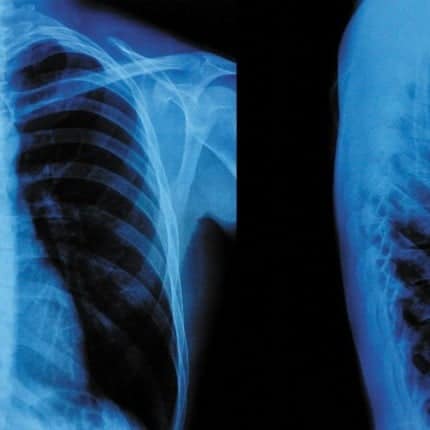 X-Ray